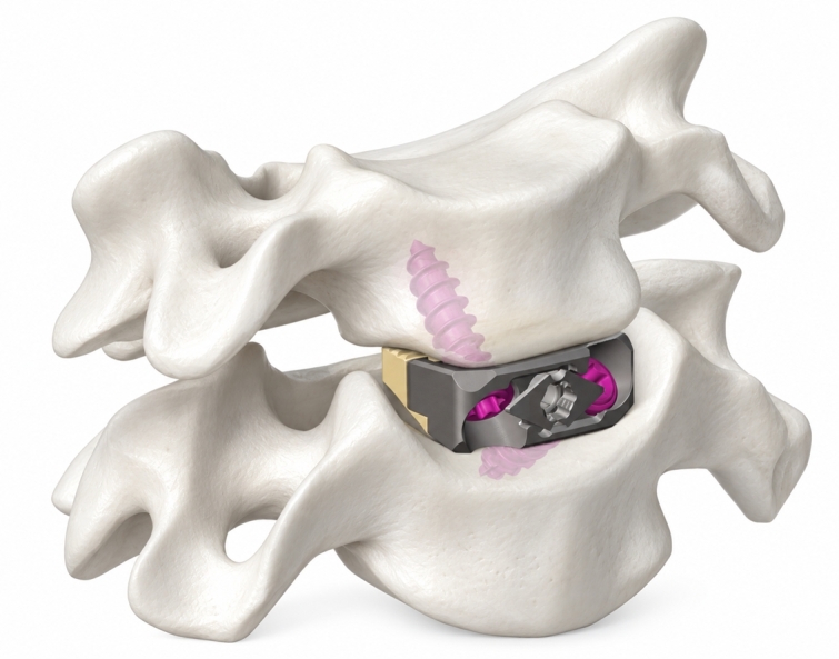 1) 메디쎄이 사진자료_넥튠 SA 경추 케이지(NeckTune™ SA Cervical Cage).jpg