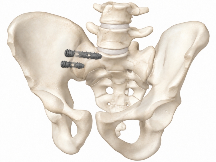 동화약품 보도사진1_Odys-SI Screw 이미지(Bone).jpg
